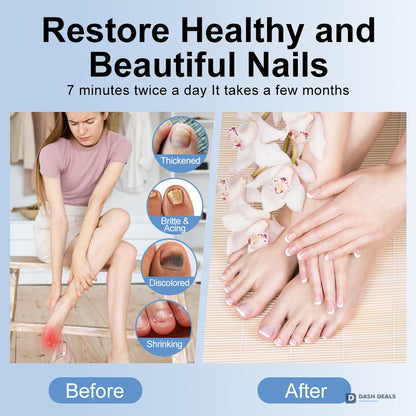 Nail Fungus Treatment LED Light - Foldable Home-Use Nail Care Device for Discolored & Thickened Toenails and Fingernails, Travel-Friendly Onychomycosis Light Therapy